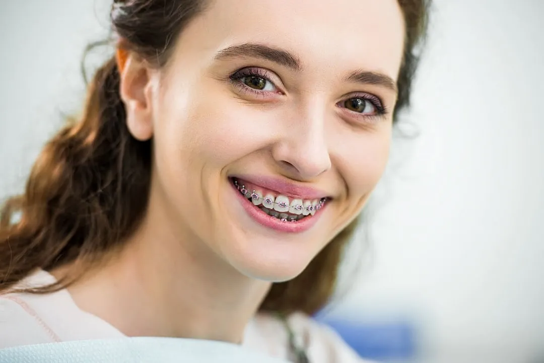 Types of Braces for Adults in Altamonte Springs, FL