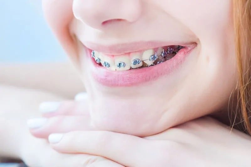 Types of Braces for Kids in Lake Mary, FL